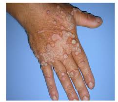 Most warts resolve within four to six months. Huge Recalcitrant Warts Treated With Pulse Dye Laser After Conventional Therapies And Others Destructive Physical Modalities Failed