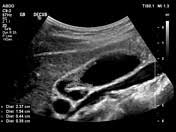 This brochure is intended to provide a general overview of a surgery. Adenomyomatosis Of The Gallbladder Radiology Reference Article Radiopaedia Org