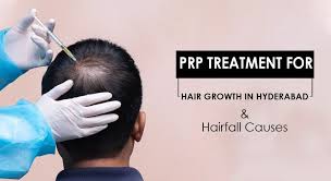 Top 10 hair fall remedies. Prp Treatment For Hair Regrowth In Hyderabad And Causes Of Hair Fall