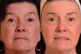 The np/pa laser utilization protocol will be as follows: Rosacea Skin Redness Tahoe Aesthetic Medicine