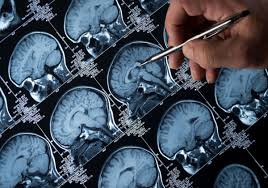 Opitz g/bbb syndrome is an inherited condition that affects several structures along the midline of the there are two forms of opitz g/bbb syndrome, which are distinguished by their genetic causes. Ultrasound Opens Blood Brain Barrier In Alzheimer Rsquo S Patients The Scientist Magazine