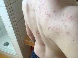Pickel Am Rucken Weg Bekommen Mit Bild Haut Akne