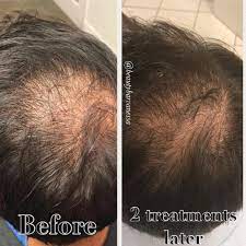 Such Amazing Results With Prp Hair Restoration After Only 2 Treatments Spaced 4 6 Weeks A Part Prp Hair Hair Restoration Effective Hair Loss Treatment