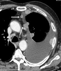 If you're looking for an exciting career, then you should consider being a radiologic technologist. Multimodality Imaging Assessment Of Malignant Pleural Mesothelioma Sciencedirect