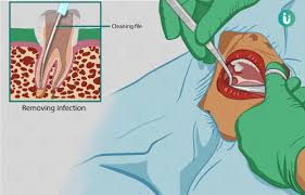 When bacteria is not cleaned from your teeth, it can turn into a. Root Canal Treatment Reasons Procedure Pain Recovery Cost Side Effects
