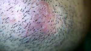 An ingrown hair occurs when a shaved or tweezed hair grows back into the skin. Keep Getting Ingrown Hair In The Same Place Popping