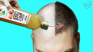 A healthy scalp is key to maintain healthy hair and preventing hair loss. 5 Miracles Of Apple Cider Vinegar For Hair Skin Vcare Hospital Virtual Health Care