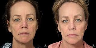 Facial Fillers Chesterfield