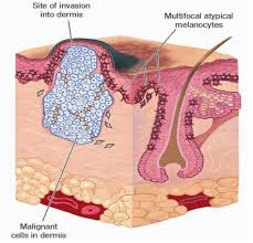 Some side effects may occur that usually do not need medical attention. Scarring Cicatricial Alopecia My Hair Doctor Prescription Haircare