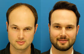 See reviews, photos, directions, phone numbers and more for the best hair replacement in fruitcove, fl. Hair Transplant In Lahore