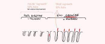 It's been around for nearly 150 years, making it an old form of hair removal. Does Hair Regrow After Electrolysis Hair Removal 2pass Clinic