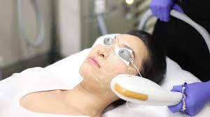 IPL - Photofacial | Vancouver Laser & Skin Care Centre