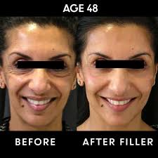 After all, when a cosmetic injectable is placed under the skin, it works to relax the muscles along the area. Discover The Secret To A Natural Look With Dermal Filler