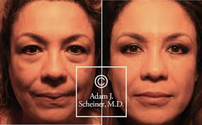 Lower lid Rejuvenation with Dr. Scheiner