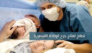 معلومات عن الولادة القيصرية لو اول مرة حامل اتفرجي لحظات ولادتك خطوة خطوة اجمل بنات