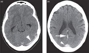 People who have had any type of stroke recover best if they get treatment right away. Cerebral Venous Sinus Thrombosis Chapter 8 Emergency Cross Sectional Radiology