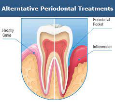 Dentist Glendale S Alternative Periodontal Treatments Laser Arestin Smile Makeover Of La
