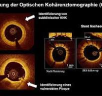 Intravaskuläre Bildgebung – Herz- und Kreislauferkrankungen ...