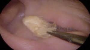 Parce qu'il faut bien trouver une utilité à la chose. Un Medecin Retire Une Boule De Coton De L Oreille De Son Patient Coincee Depuis 2 Ans