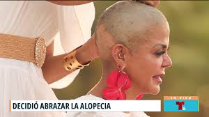 Padecimiento de alopecia cambió su vida