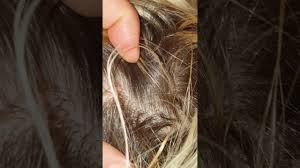 Aloe vera or petroleum jelly can be applied to the scalp until the injured area heals and scabs over. 1 Good Scalp Scab Picking Scratching With Fingernails Dandruff On My Sister Asmr Hair Little Talking Youtube