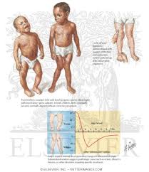 Image result for Genu Varum