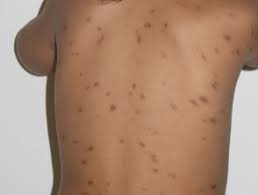 The classic coffee drink taken to new heights with the flavors of baileys original irish cream and a touch of your favorite whiskey. Mastocytosis Dermnet Nz