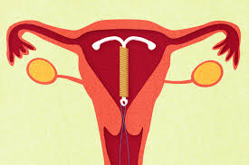 8 Things You Need To Know About Sex When You Have An IUD