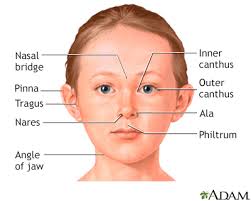 The epicanthic or epicanthal folds are either of no significance whatsoever or a potential disease marker, especially they also usually have a protruding tongue and tiny ears. Epicanthal Folds Information Mount Sinai New York