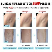 I went for a free consultation for laser hair removal. Amazon Com Laser Hair Removal Permanent Imene Painless Ipl Hair Removal Ideal For Women Men Bikini Legs Arms Armpits Hair Remover Uses Most Effective Ipl Technology Intense Pulsed Light Blue
