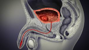 Bladder Cancer Treatment Here S All You Need To Know