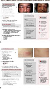 This edema is granulomatous in nature, thought to be due to chronic inflammation of the cutaneous vessels. Chronic Urticaria And Recurrent Angioedema Clues To The Mimics Sciencedirect