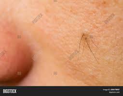 Wart is very slow growing and long duration lesion. Closeup View Caucasian Image Photo Free Trial Bigstock