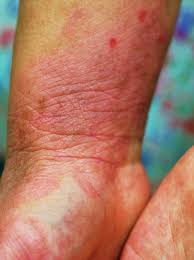 Wound care that you do at home. Neurodermitis Atopisches Ekzem Ursachen Therapie Derma Plus
