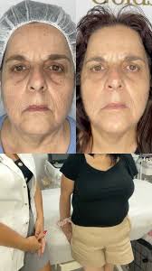 5 חודשים בלבד תוצאה של 10 שנים פחות עם בוסט GOLD ✨, היא נכנסה לקליניקה שלי  עם עיניים עייפות ולב כבד., “אני לא מרגישה טוב עם איך שאני נראית” היא לחשה  כמעט בשקט, והיה אפשר לראות כמה זה נוגע לה עמוק ...