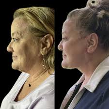 Face-lift and Neck-lift Procedure Experience and Results