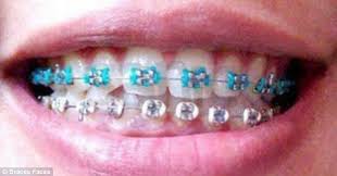 Maybe you would like to learn more about one of these? Fake Braces Trend Is A New Status Symbol For Asian Teenagers But Could They Kill Wearers Daily Mail Online