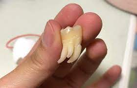 NHỔ RĂNG KHÔN UY TÍN TẠI NHA KHOA TÂM VIỆT - Nha khoa uy tín quận Gò Vấp TPHCM | Nha khoa Tâm Việt