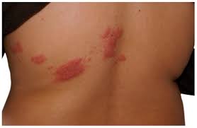 Image result for herpes zoster