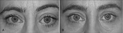Exophthalmos , also spelled exophthalmus , also called proptosis , abnormal protrusion of one or both eyeballs. A Preoperative Photograph Shows Exophthalmus Of The Left Eye B Download Scientific Diagram