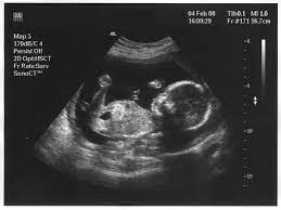 Maybe you would like to learn more about one of these? Boleh Ke Upload Gambar Scan Bayi Di Facebook Sayidahnapisahdotcom