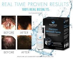 Alopecia, or hair loss, affects tens of millions of americans, according to the national. Minoxidil Hair Regrowth Hair Loss Treatment For Male Alopecia