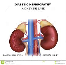 Changing your diet to meet your body's lower protein needs balancing nutrition and making recipes you are used to can be difficult. Type2 Diabetes And Health Related Issues Food Recipes How To Reverse Kidney Damage From Diabetes