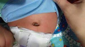 Ombligo Infectado Club De Bebes Abril 2018 Babycenter