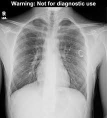 Pneumothorax is defined as air that has entered the pleural space, either spontaneously or as a result of traumatic tears in the pleura after chest injury or . Pneumothorax