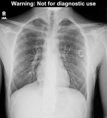 Persistent spontaneous pneumothorax in an adolescent with marfan's. Pneumothorax