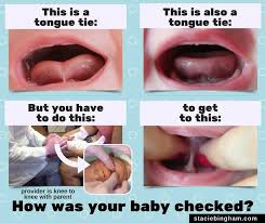 Tongue Tie In 2020 Tongue Tie Baby Tongue Doctor For Kids