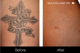 There's a little more to the process than going to your sessions, however. Laser Tattoo Removal Clinic Toronto See Our Before Afters