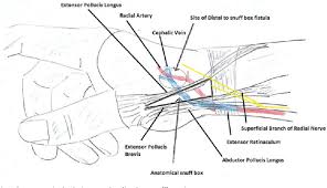 Figure 3 From Distal To Snuffbox Arteriovenous Fistula Semantic Scholar The scaphoid has a unique blood supply, which runs. snuffbox arteriovenous fistula