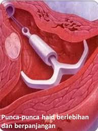 Kenapa cari petua hilangkan gastrik bila sudah ada tanda gastrik? Punca Punca Haid Berlebihan Dan Berpanjangan Wannura Terapi